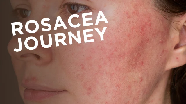 glutathione rosacea The Latest on Rosacea