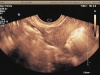 Sono HSG Procedure using ABBI: Fallopian Tube Patency 1