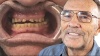 A Dental Implant Story - He Forgot He Could Smile