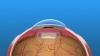 Toric Lens Implants
