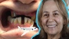 travel for dental implants