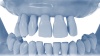 All-on-4 Dental Implant Illustration