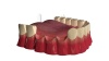 Dental Implant Bridge Illustration
