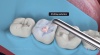 Illustration of a dental procedure showing a dental tool filling a cavity on a molar