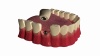 Single Tooth Implant Illustration