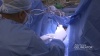 Advincula Delineator Uterine Manipulator - Use in Surgery - Testimonials 1