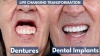 A Dental Implant Story - Dentures vs Dental Implants Doctors Were Worried About His Health
