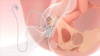 Fetal Pillow Balloon Cephalic Elevation Device for Cesarean Sections 3